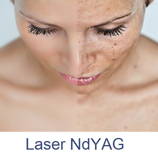 Laser NdYAG Q-switched