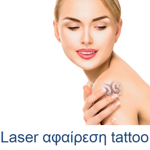 Laser αφαίρεση tattoo